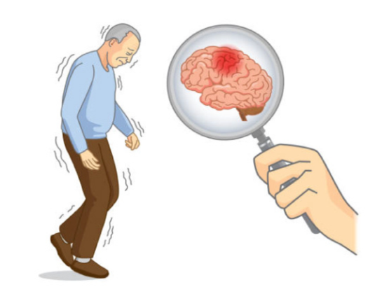 Best-parkinsons-treatment-near-attapur